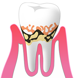 軽度歯周炎
