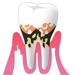 中度歯周炎